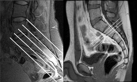 Does Lumbar Mri Include Sacrum Mapasgmaes